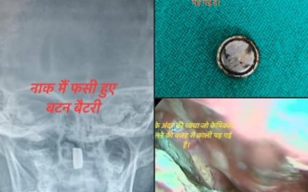 चम्पावत: ढाई वर्षीय बच्चे की नाक में फंसी बैटरी, डॉक्टरों ने बचाई जान