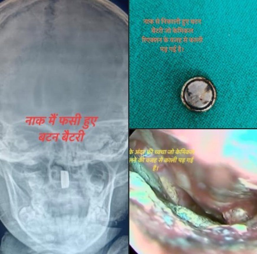 चम्पावत : मासूम के नाक में फंसी बटन बैटरी, जिला अस्पताल के डॉक्टर ने दिया नया जीवन