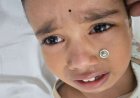 टनकपुर अस्पताल के डॉक्टर्स की कुशलता से बची मासूम की जिंदगी, बिना ऑपरेशन निकला नाक में फंसा धातु का बटन