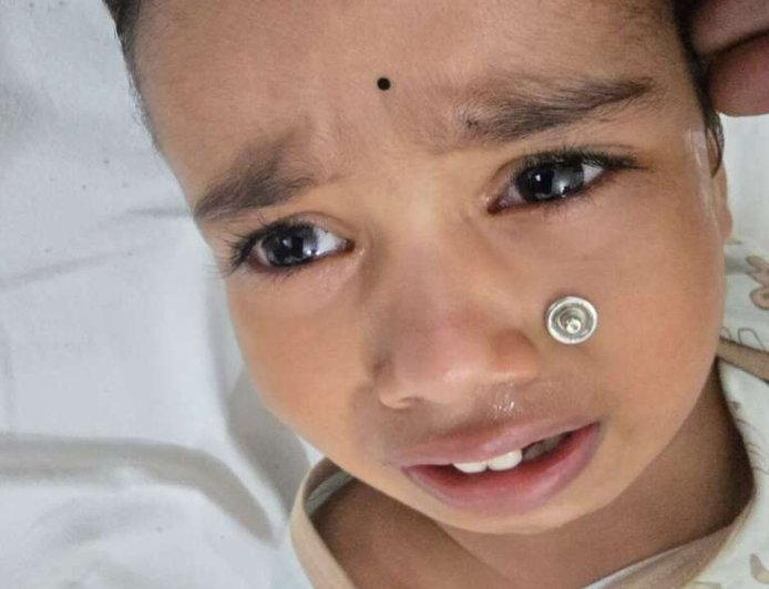 टनकपुर अस्पताल के डॉक्टर्स की कुशलता से बची मासूम की जिंदगी, बिना ऑपरेशन निकला नाक में फंसा धातु का बटन
